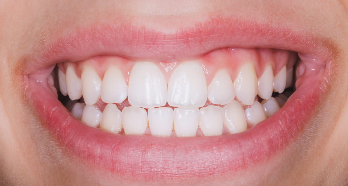 gingivectomia que es