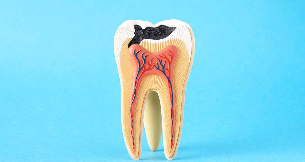 como saber si tengo caries sintomas